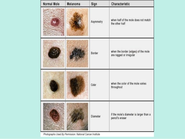 Wet panties young girls juicy cunt gang Picture of cancerous moles by the anus